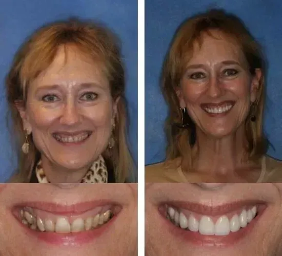 A before and after photo of a woman 's smile