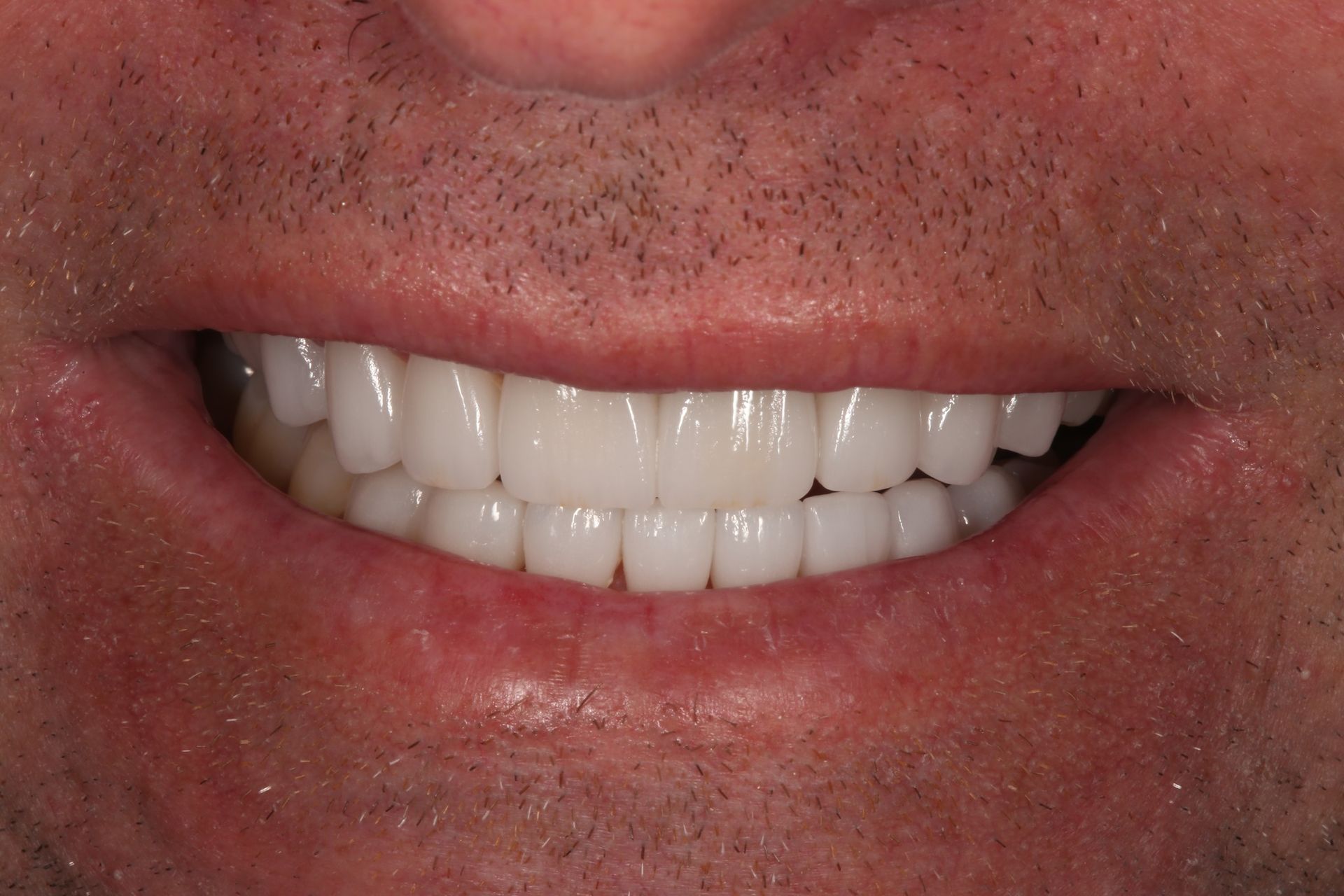 A close-up of a person smiling, showing a full set of straight, bright white upper and lower teeth.