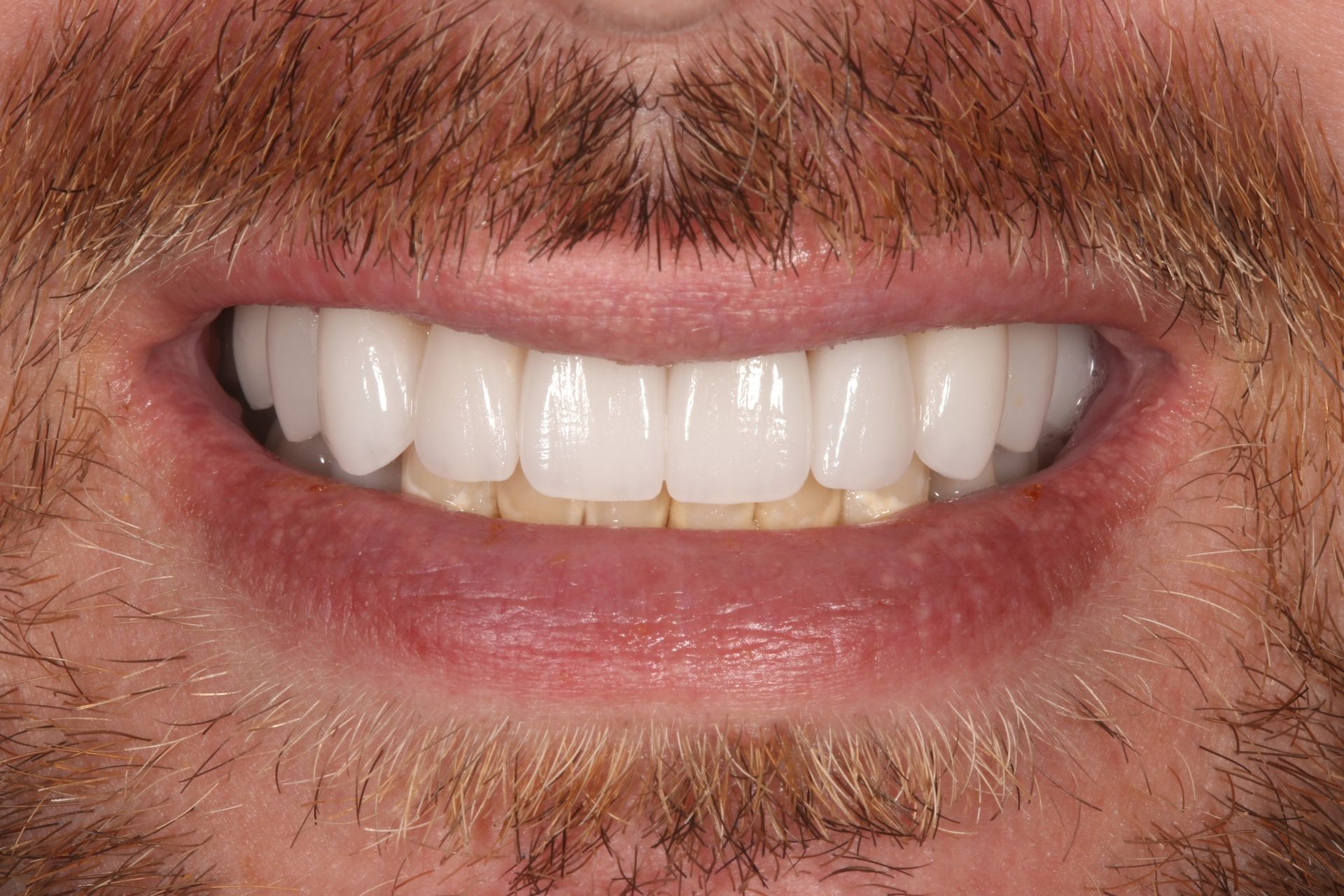 Close-up of a person with a beard smiling to show a set of bright, white, uniform teeth.