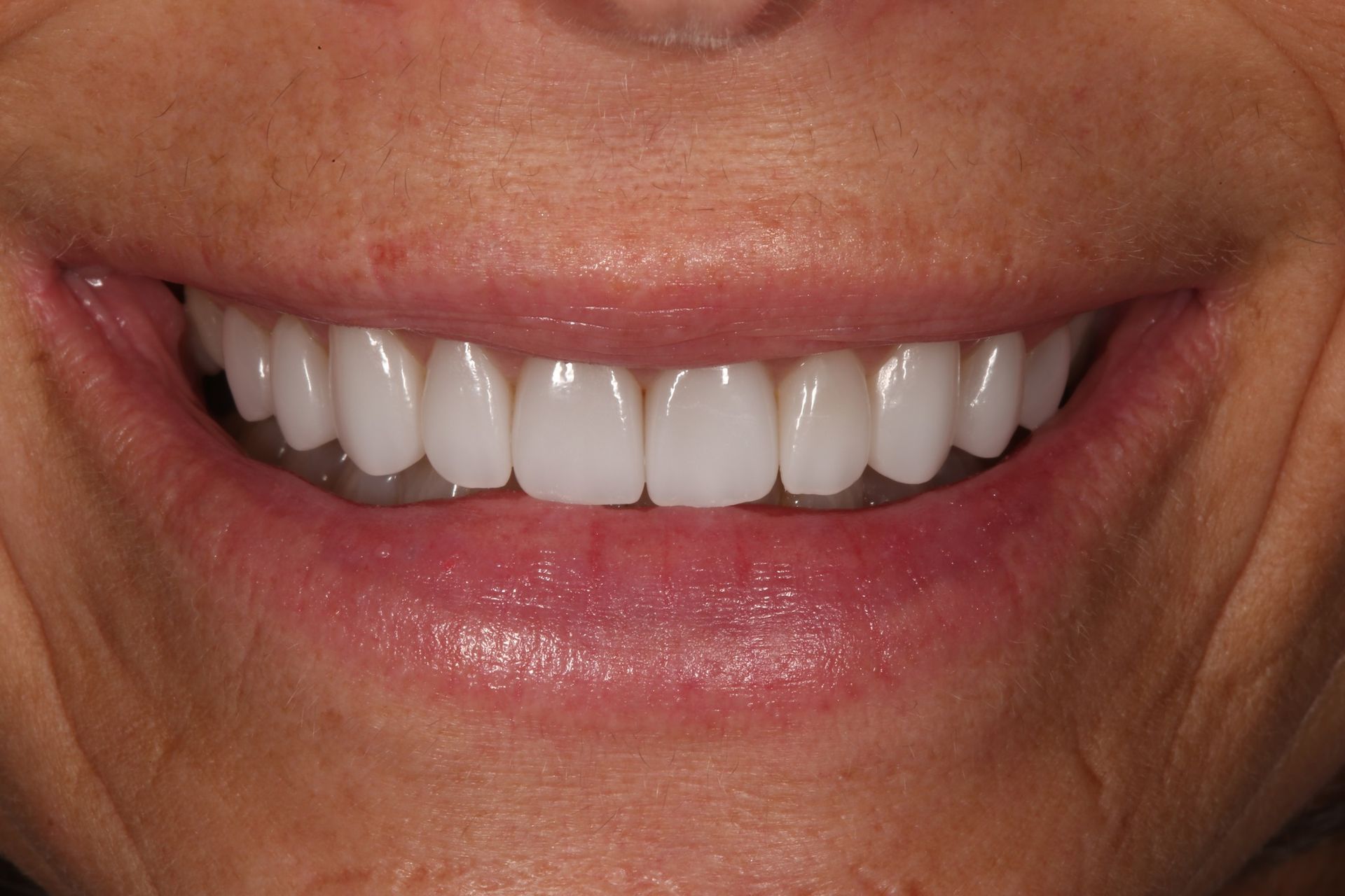 A close-up of a person's smiling mouth, showing a full set of bright, uniform, and well-aligned teeth.