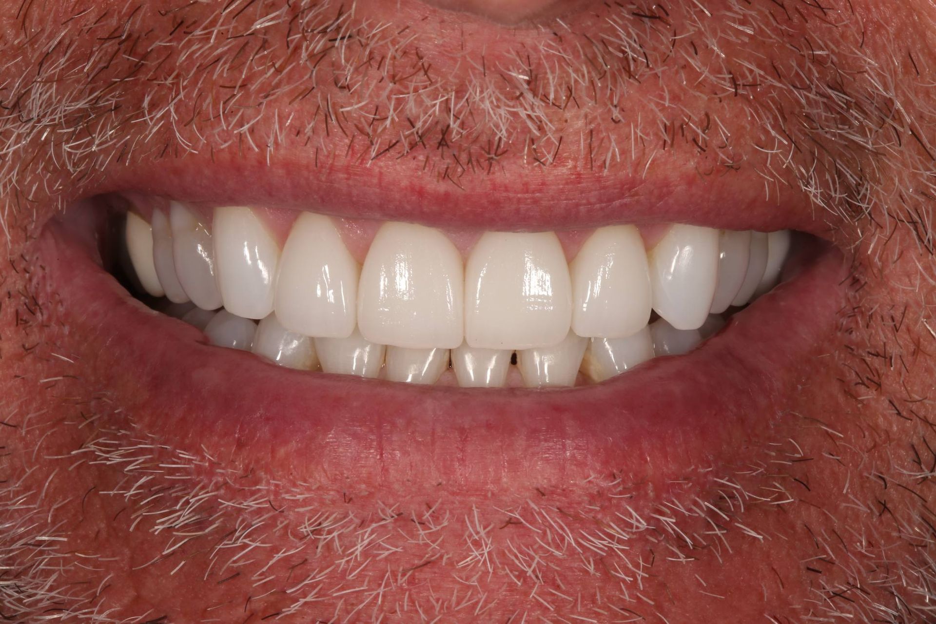 A close-up of a person's mouth displaying a set of bright, uniform dental veneers.