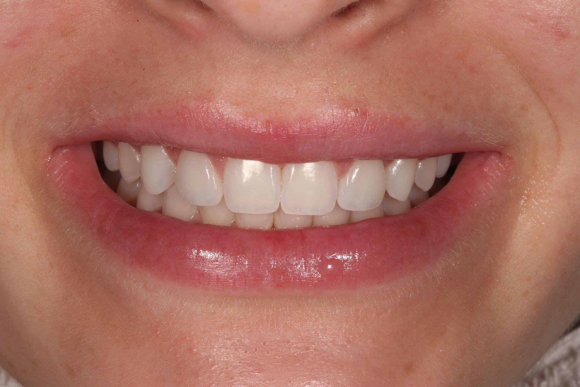 Close-up of a person’s lower face, showing a neutral, closed-mouth smile displaying healthy, white, even teeth.