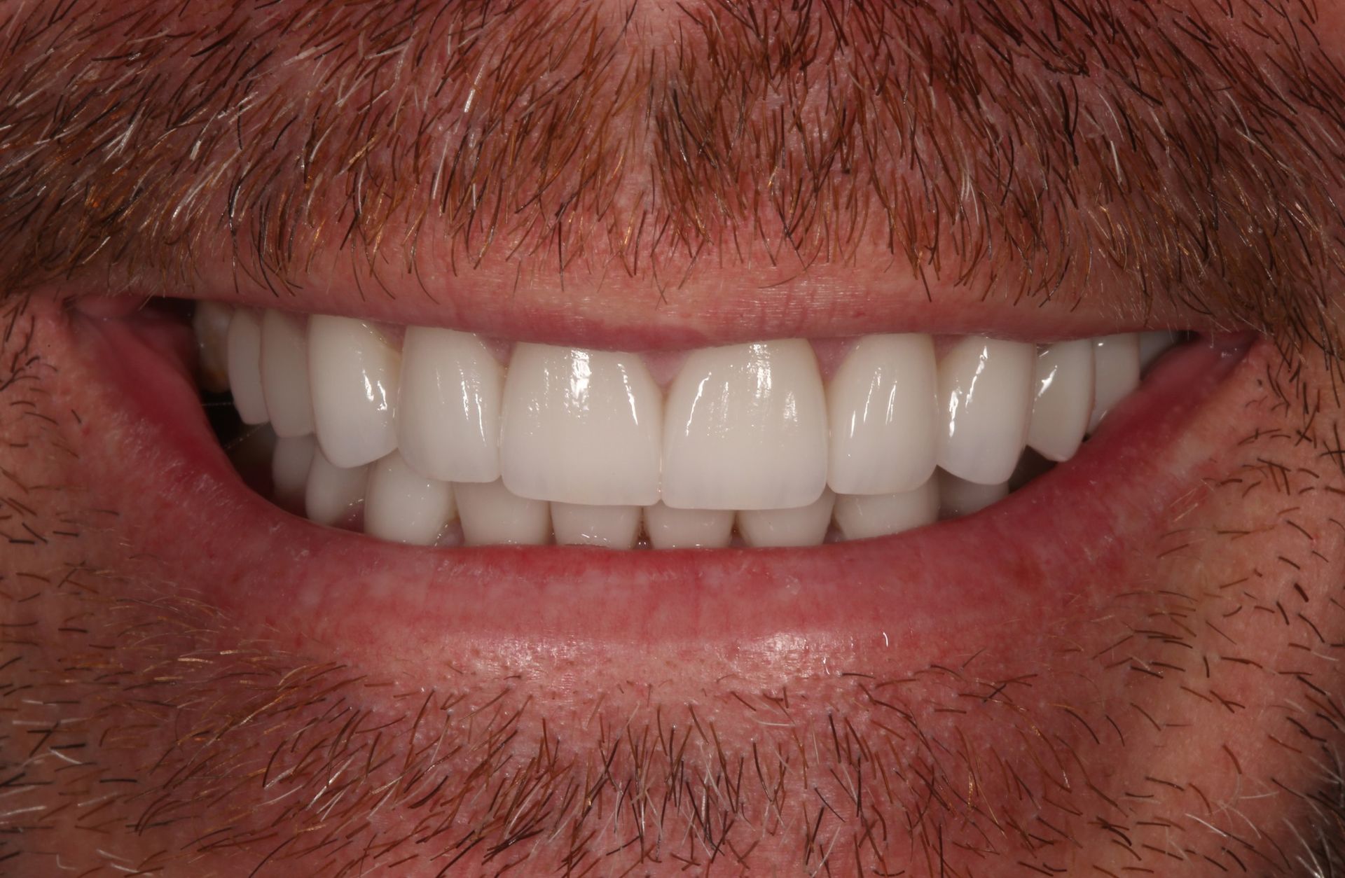 Close-up of a person’s lower face showing a straight, bright white, restored smile with veneers or crowns.
