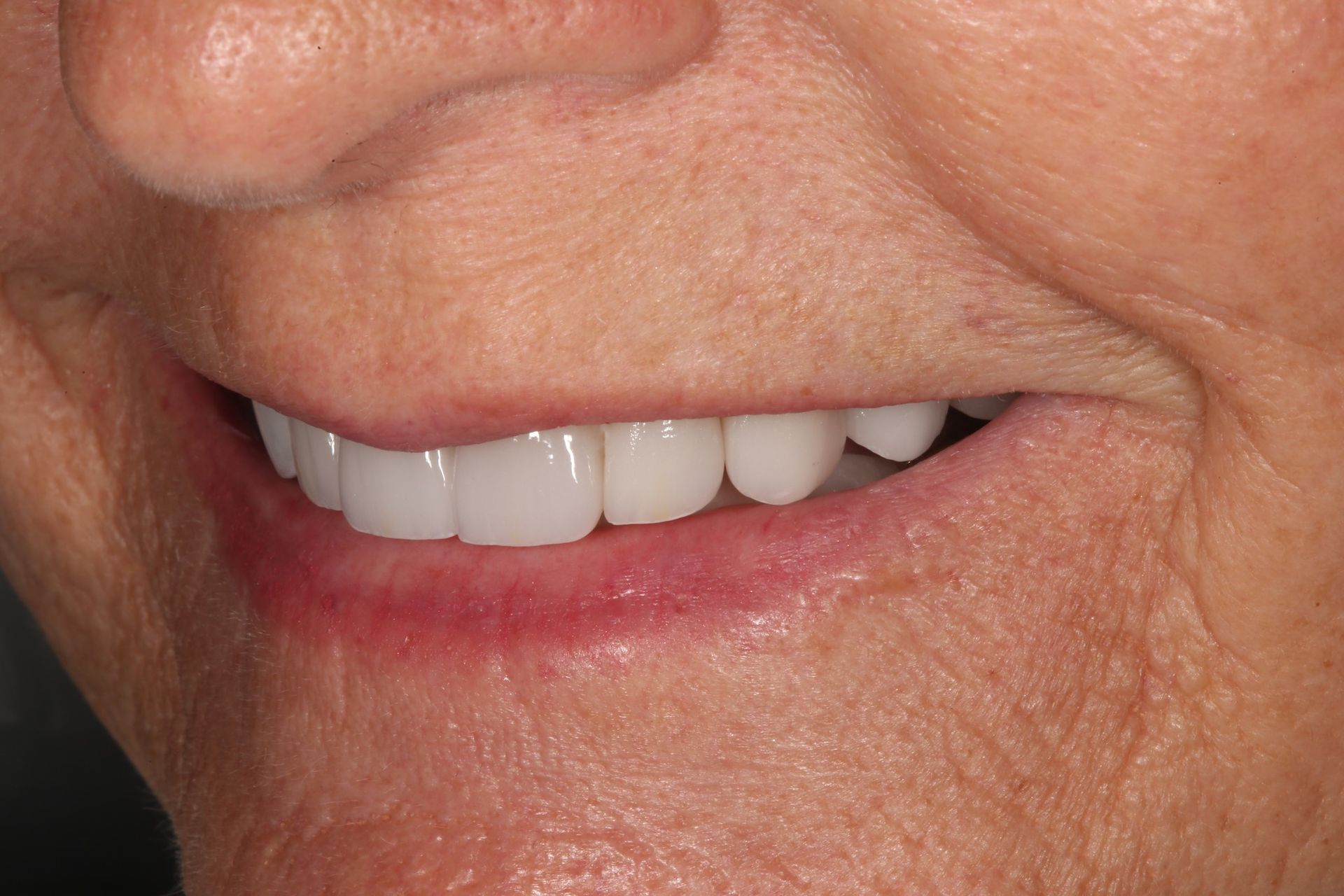 A close-up view of a person smiling, showcasing a set of straight, bright white upper teeth.