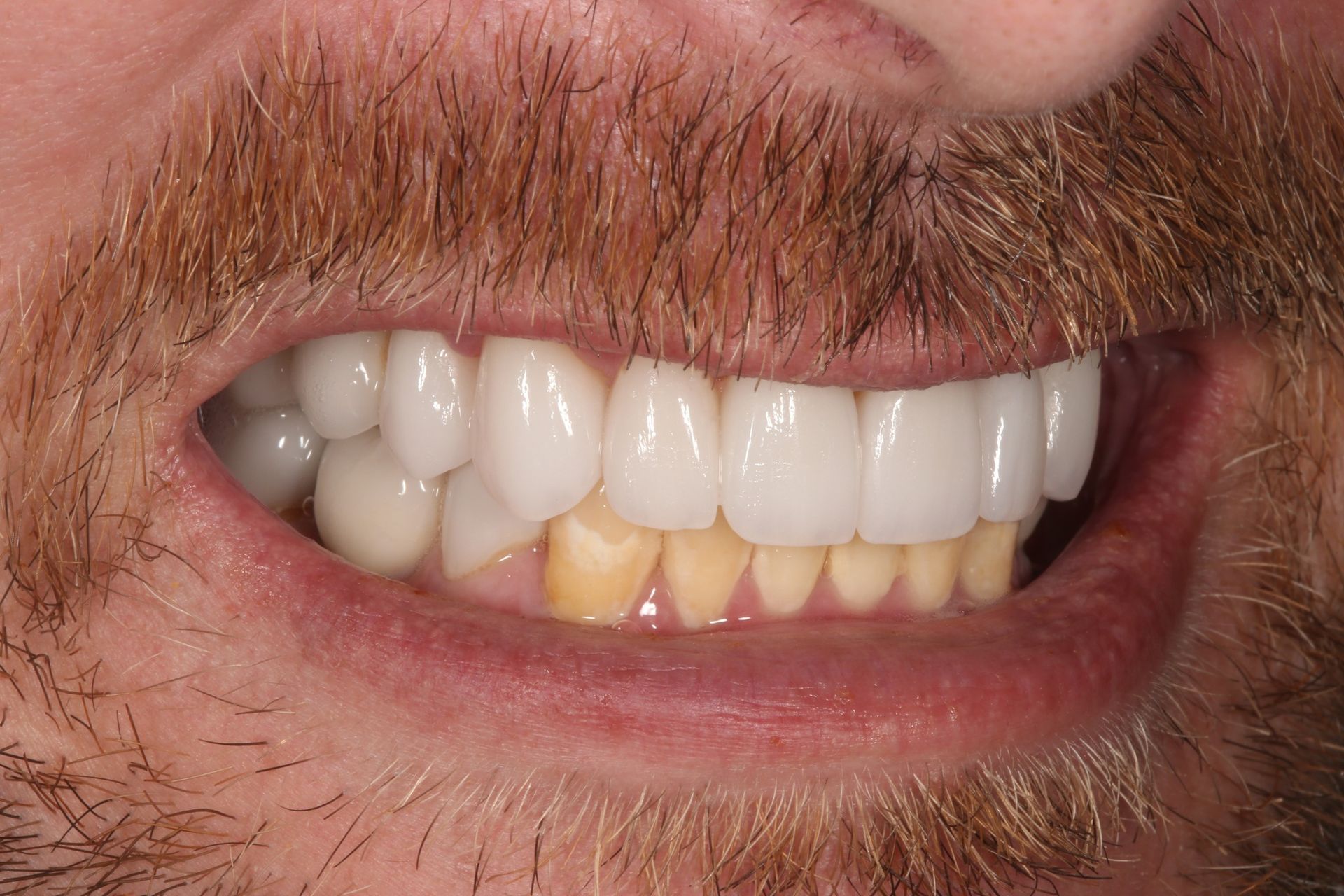 Close-up of a mouth showing upper teeth with bright white veneers and natural-colored lower teeth.