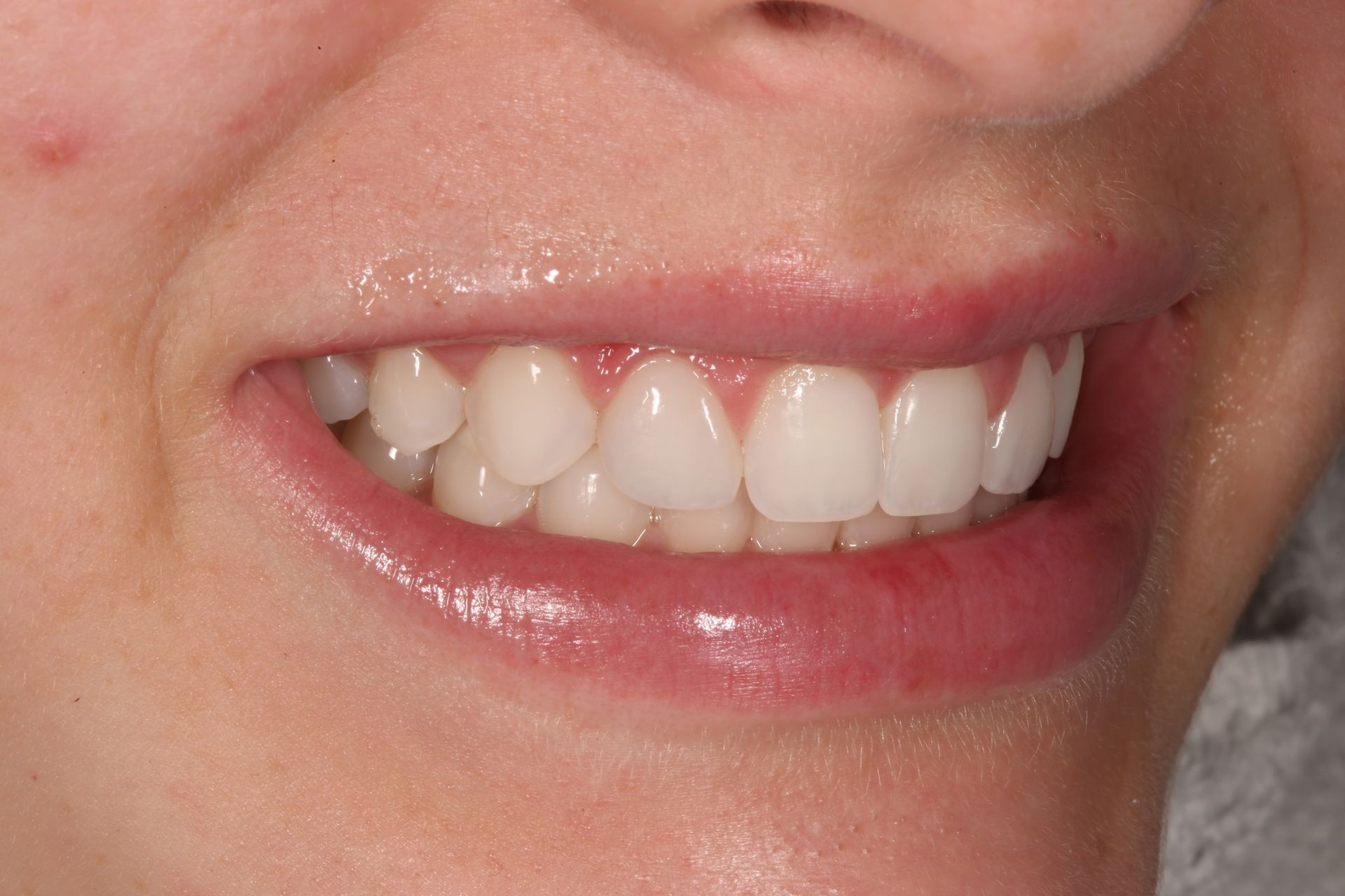 A close-up view of a smiling mouth showing clean, straight teeth.
