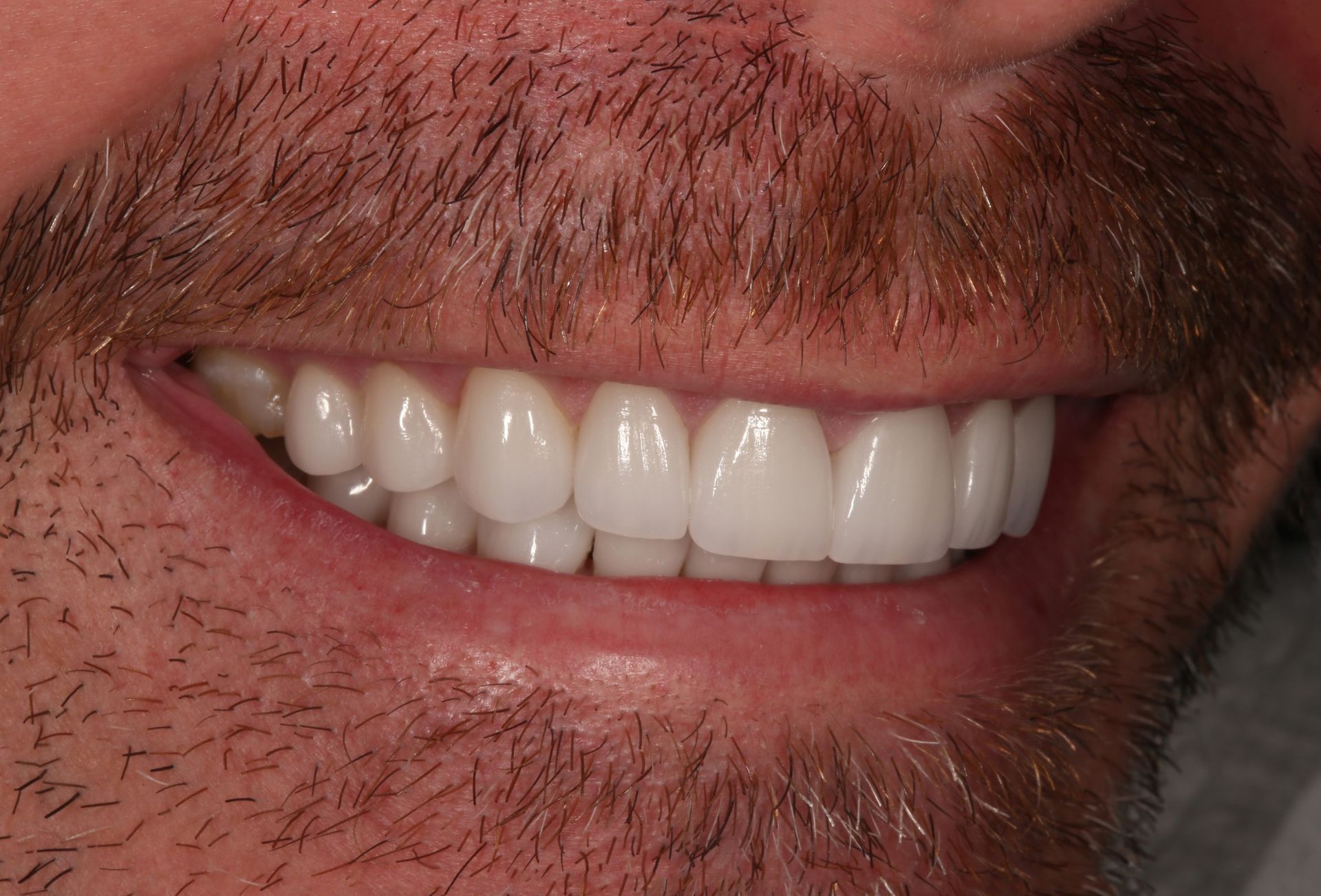 A close-up of a person's lower face showing a bright, even smile with natural-looking teeth.
