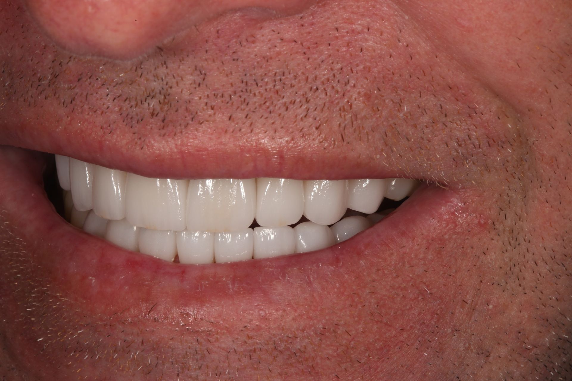 Close-up view of a person’s mouth showing straight, white dental veneers or crowns.