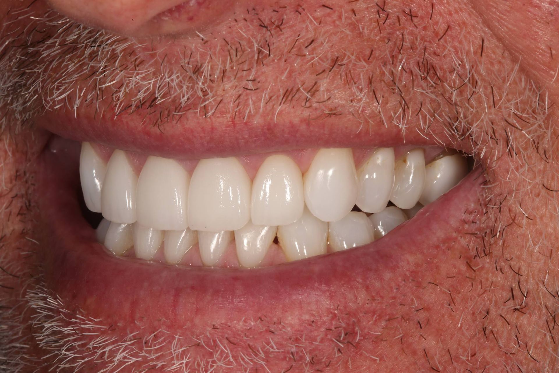 A close-up view of a smiling mouth showing a full set of white, well-aligned teeth and dental crowns.