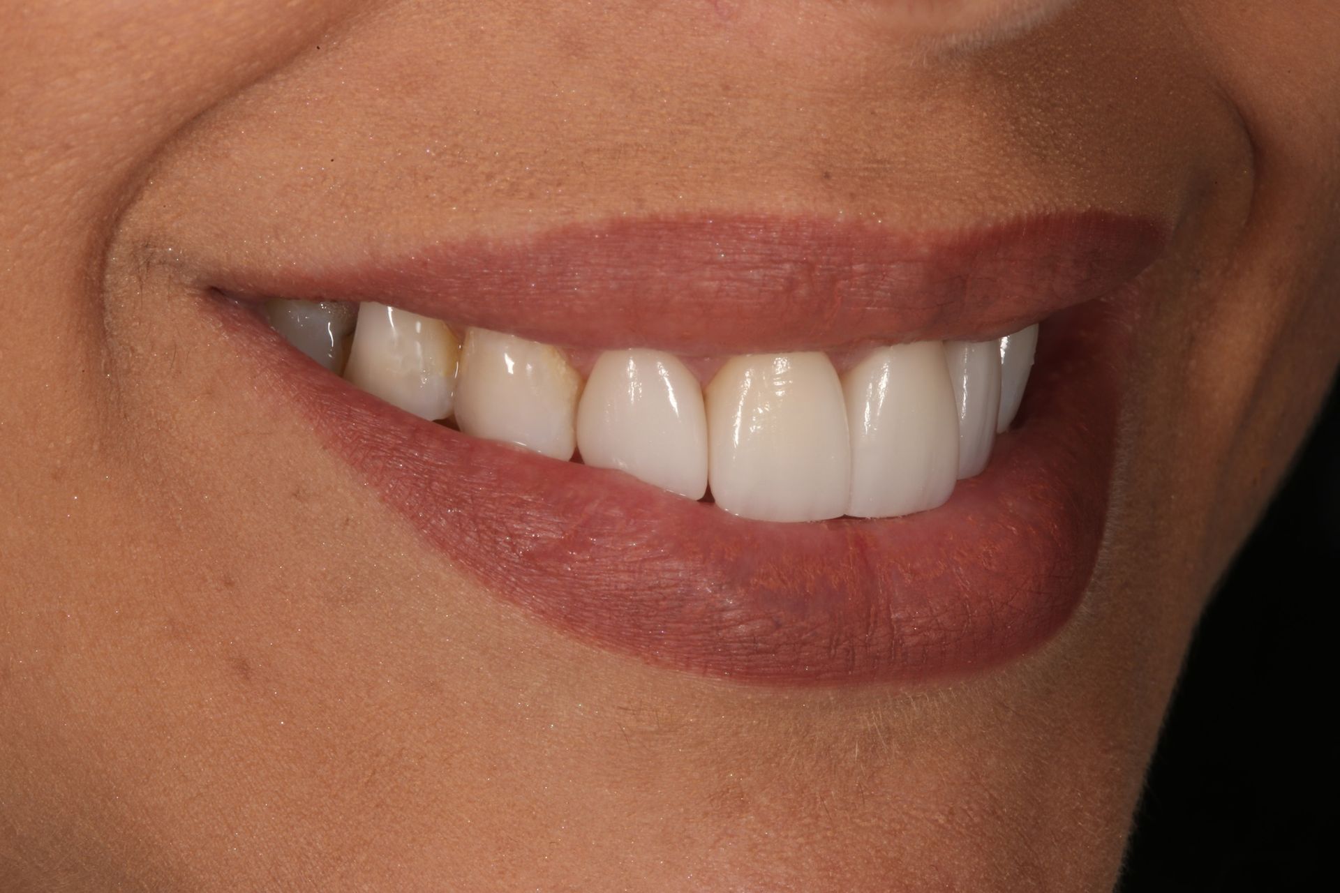 Close-up of a person’s smile showing healthy, white upper teeth and natural lips.