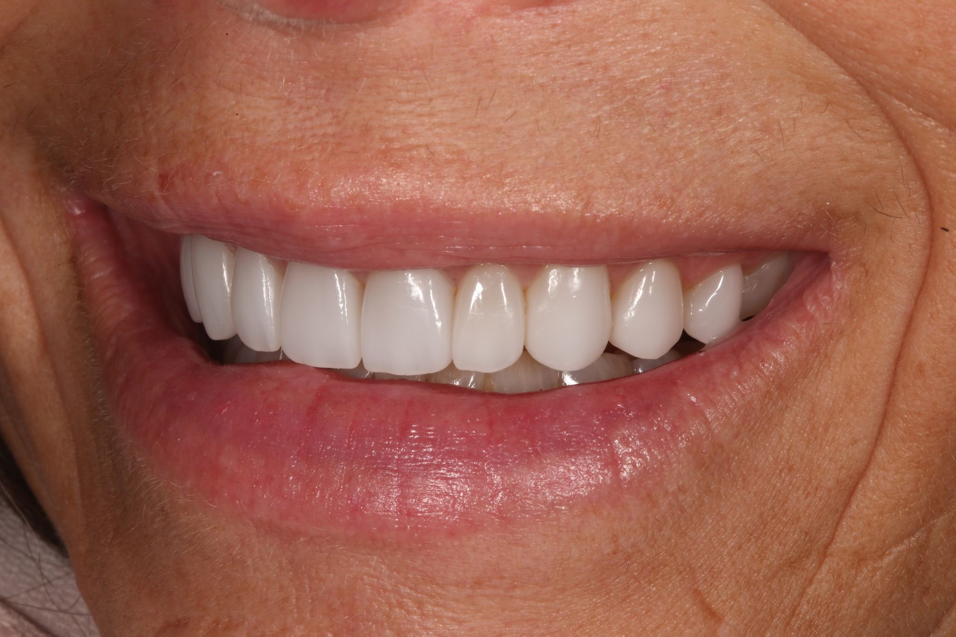A close-up view of a smiling mouth displaying a row of bright, uniform, and natural-looking teeth.