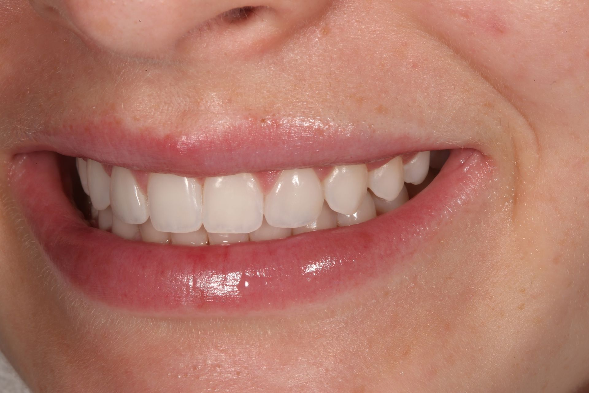 A close-up view of a person’s mouth showing straight, white teeth while smiling.