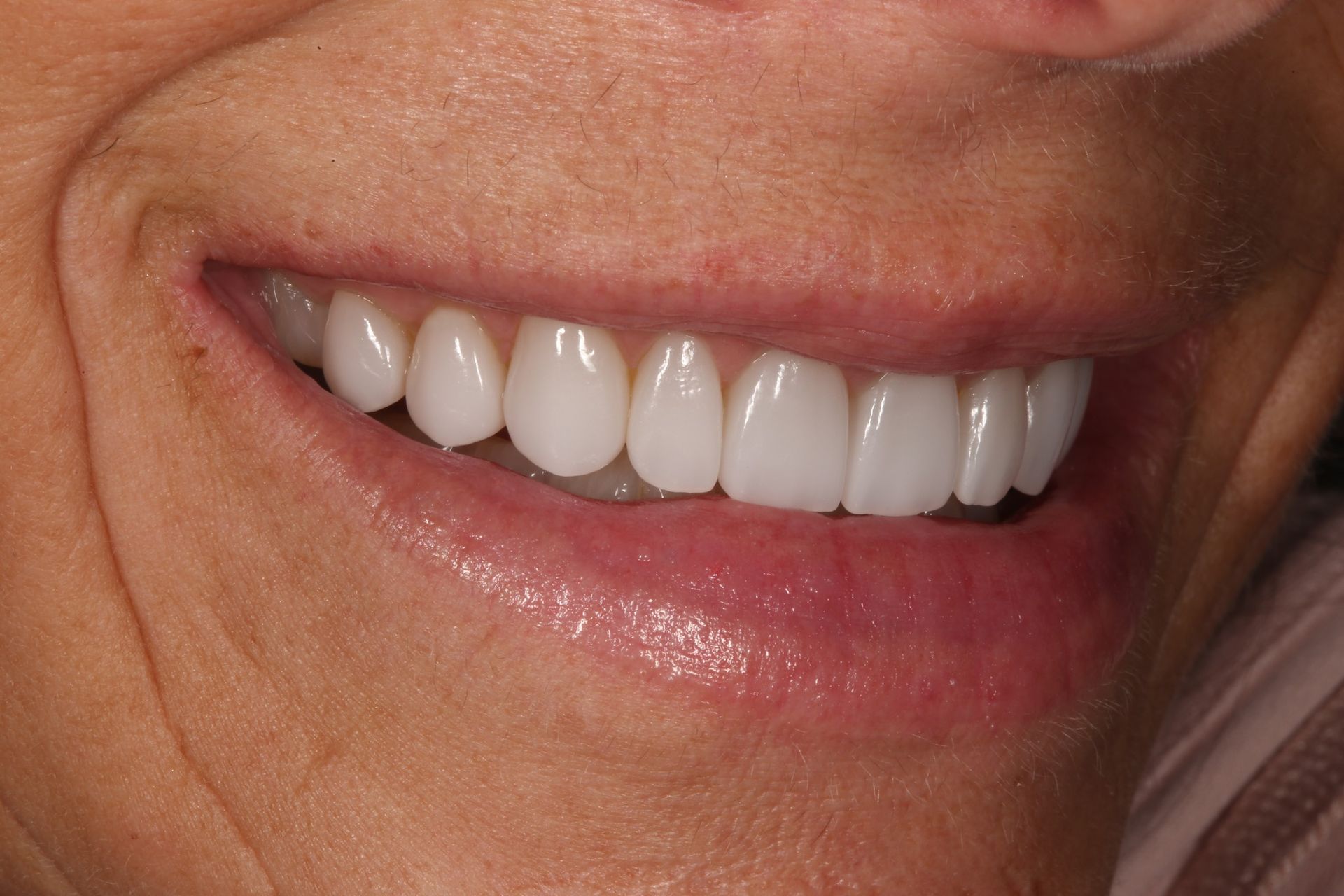 A close-up of a person smiling, showing a straight, white, and well-aligned set of upper teeth.