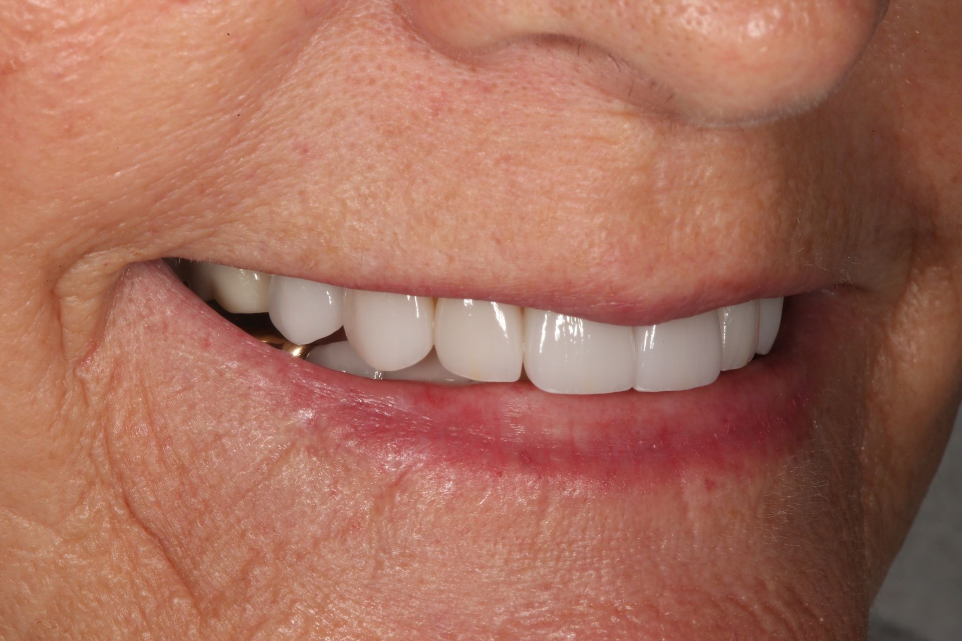 Close-up view of a person’s lower face showing natural-looking dental veneers on the upper teeth.
