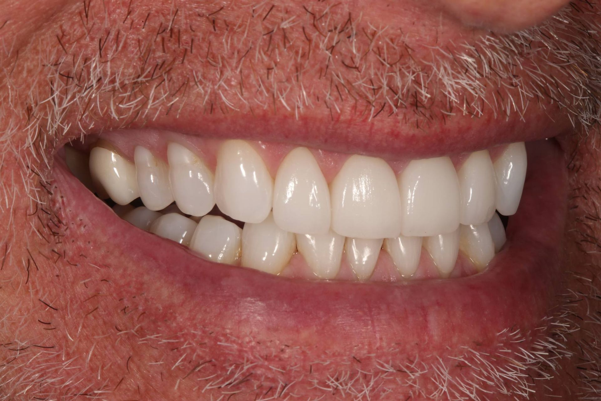 Close-up of an individual’s mouth with a natural, bright, and healthy smile showing straight, well-aligned teeth.