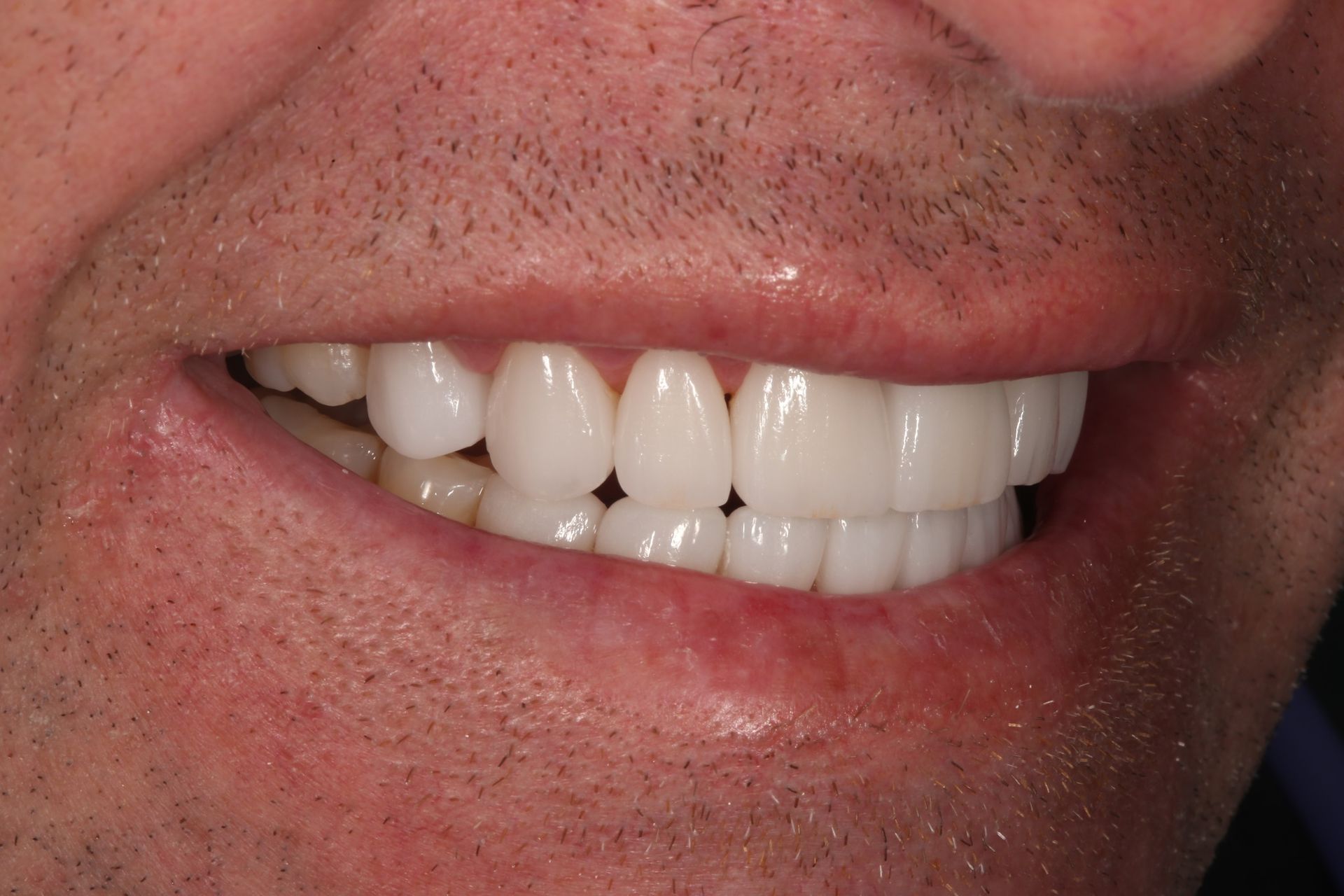 Close-up of a person's mouth showing white teeth and healthy gums while smiling.