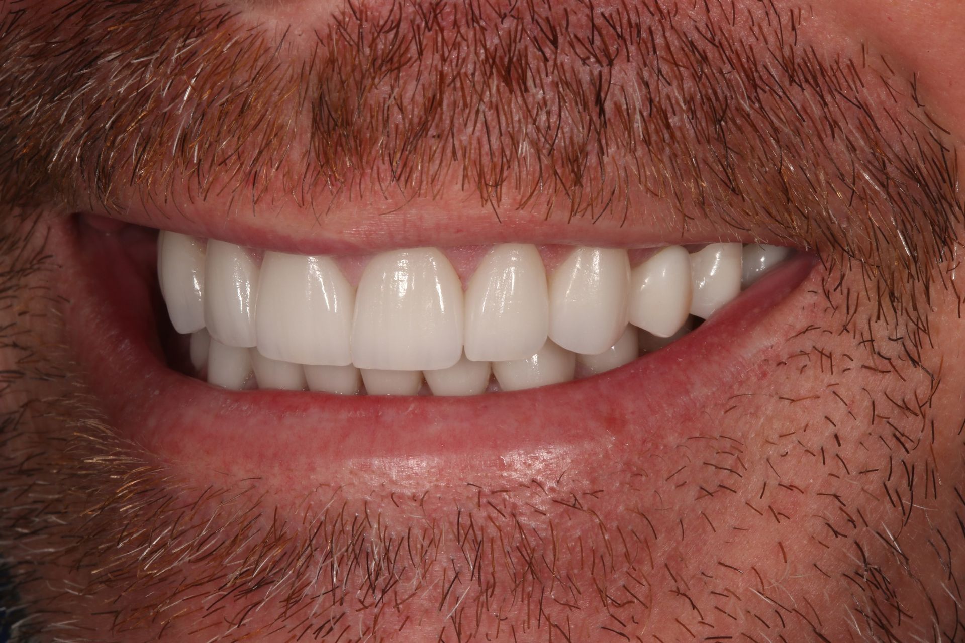 A close-up of a person's smiling mouth, showing a full set of white, well-aligned teeth.