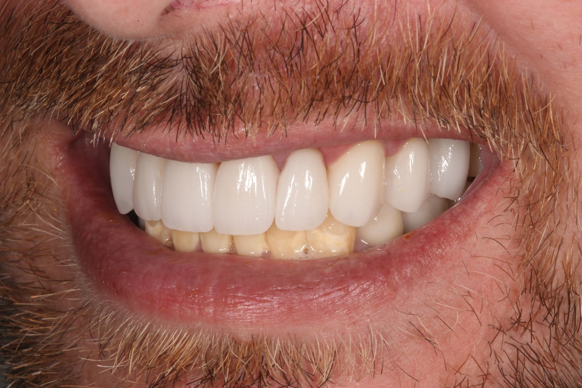 Close-up of a smiling mouth displaying a row of bright white upper teeth above a row of natural-colored lower teeth.