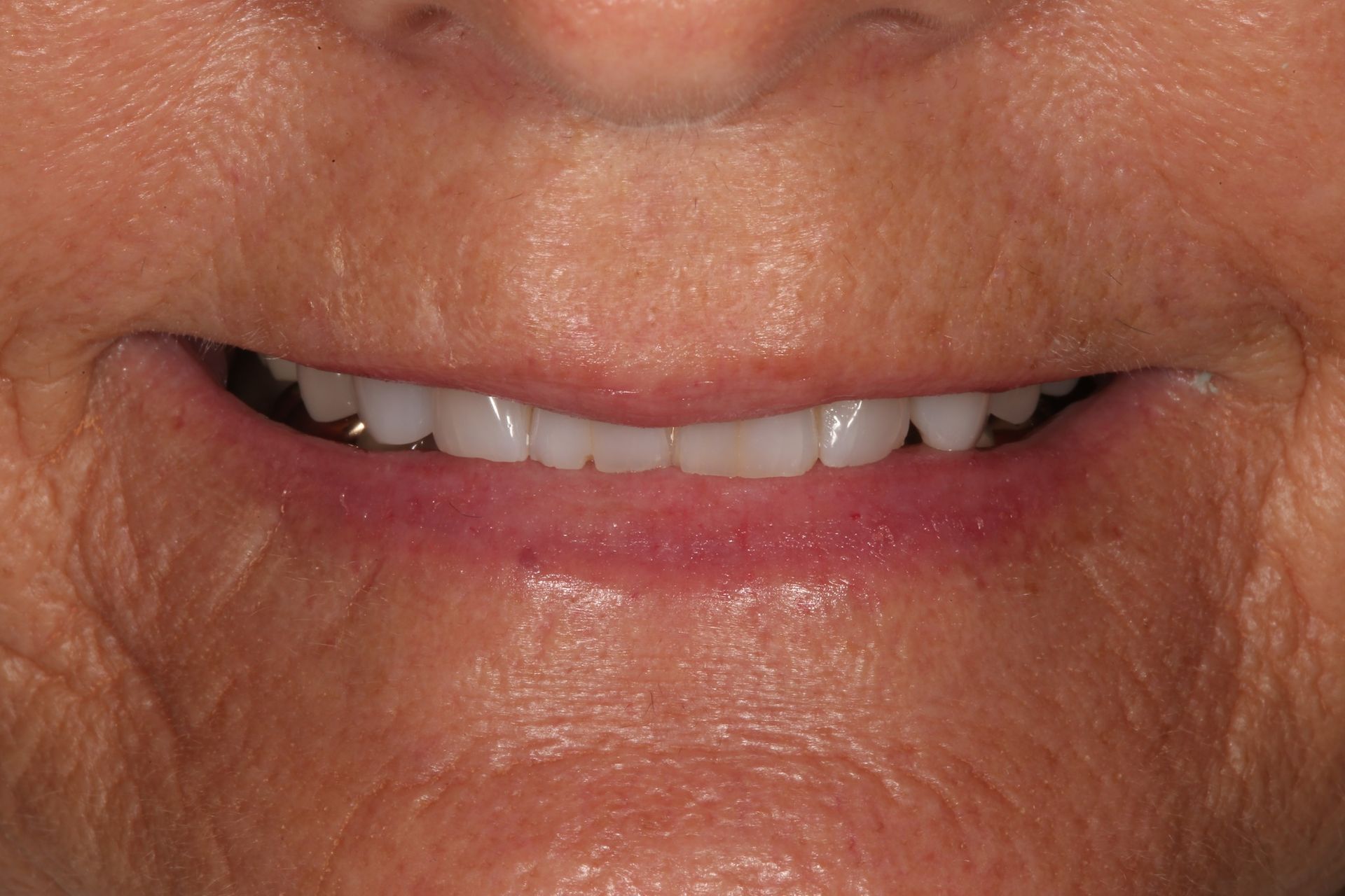 Close-up of a person's mouth showing a white, natural-looking smile with teeth fully visible.