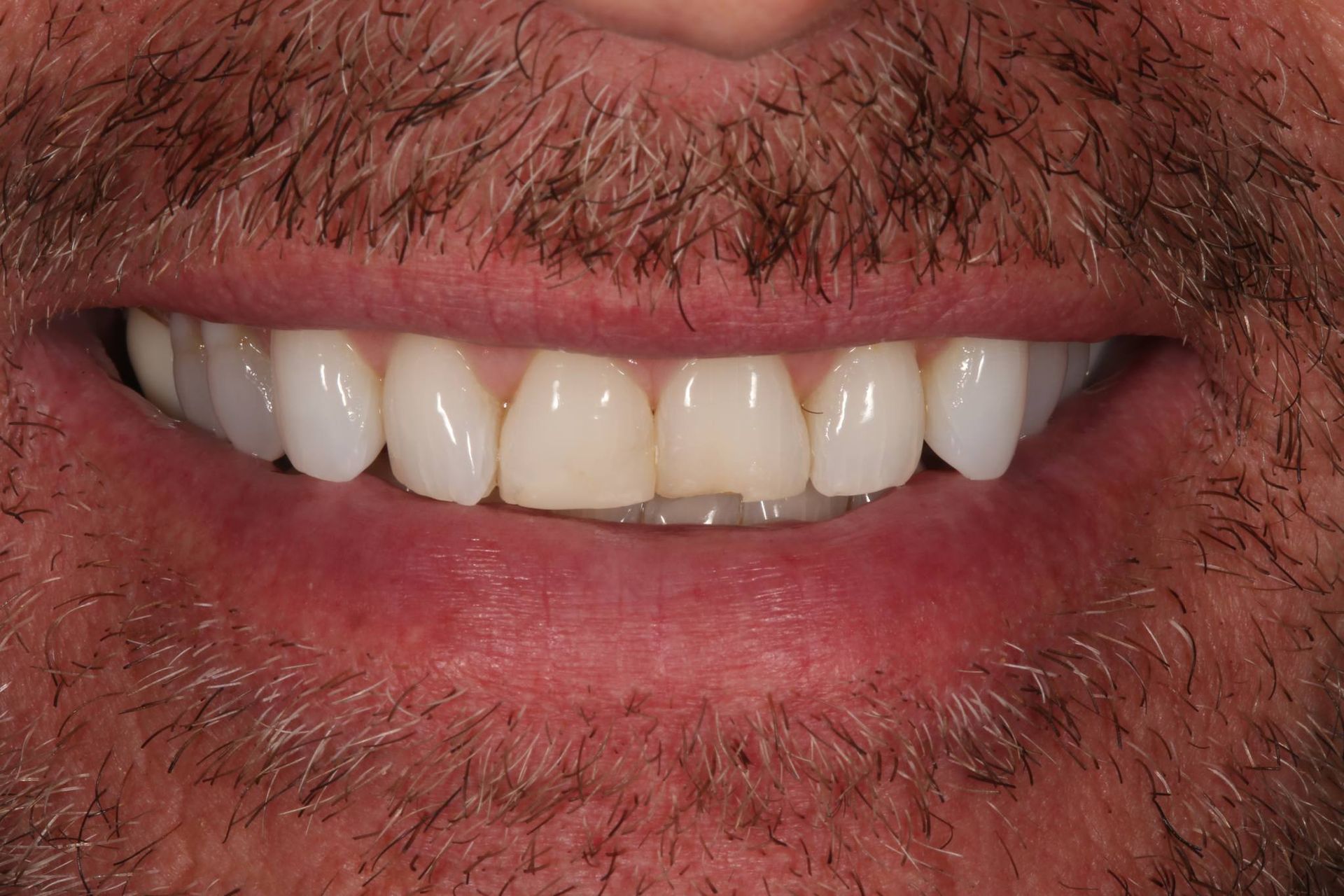 A close-up of a person's mouth with white teeth, highlighting a slight color difference in the front two teeth.