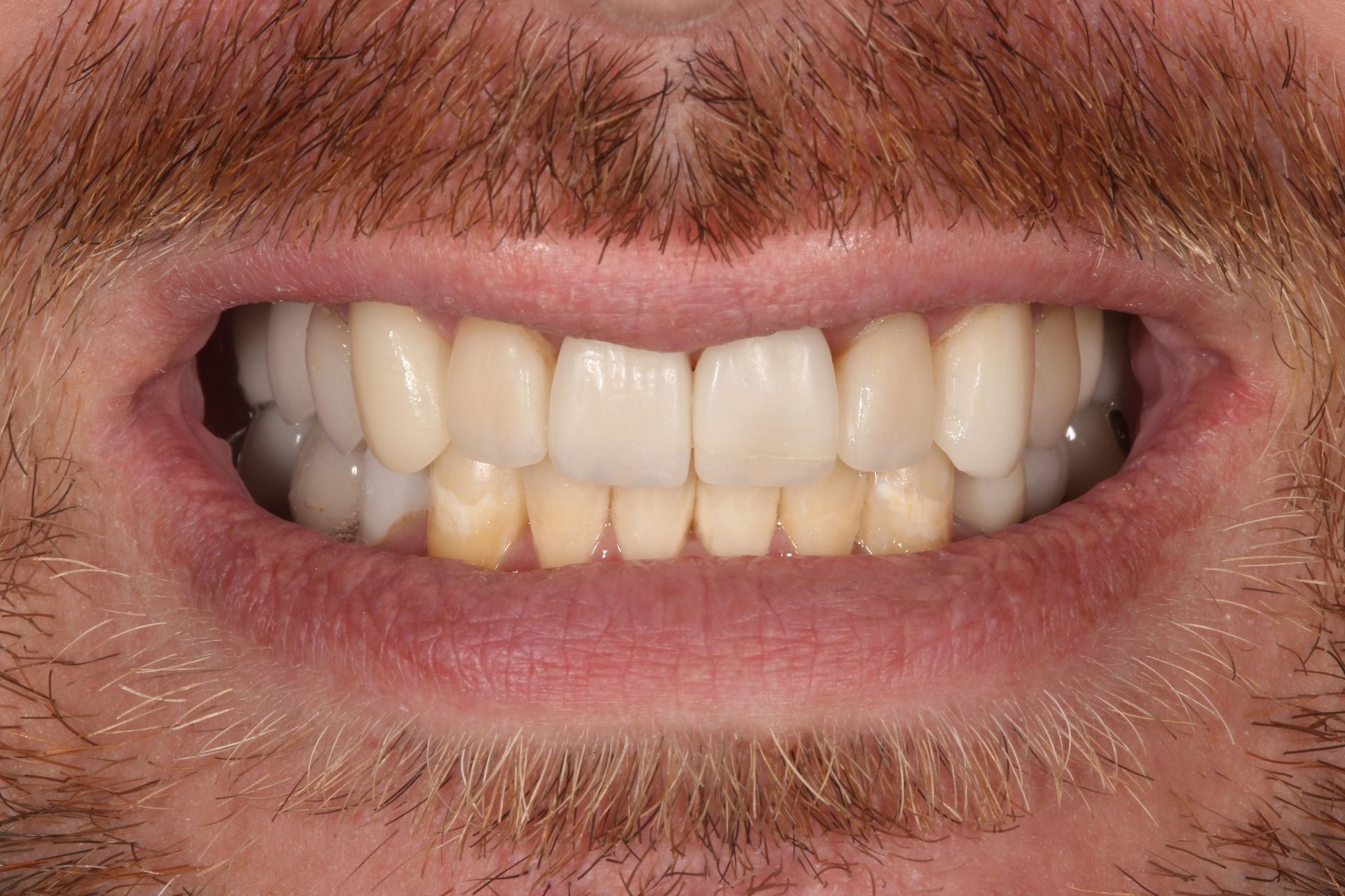 A close-up of a person's mouth displaying unevenly colored and textured upper and lower teeth with a neutral expression.