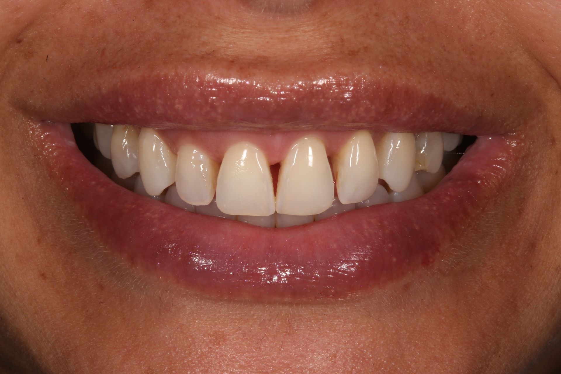 A close-up of a person smiling, showing teeth with a small gap between the two upper central incisors.