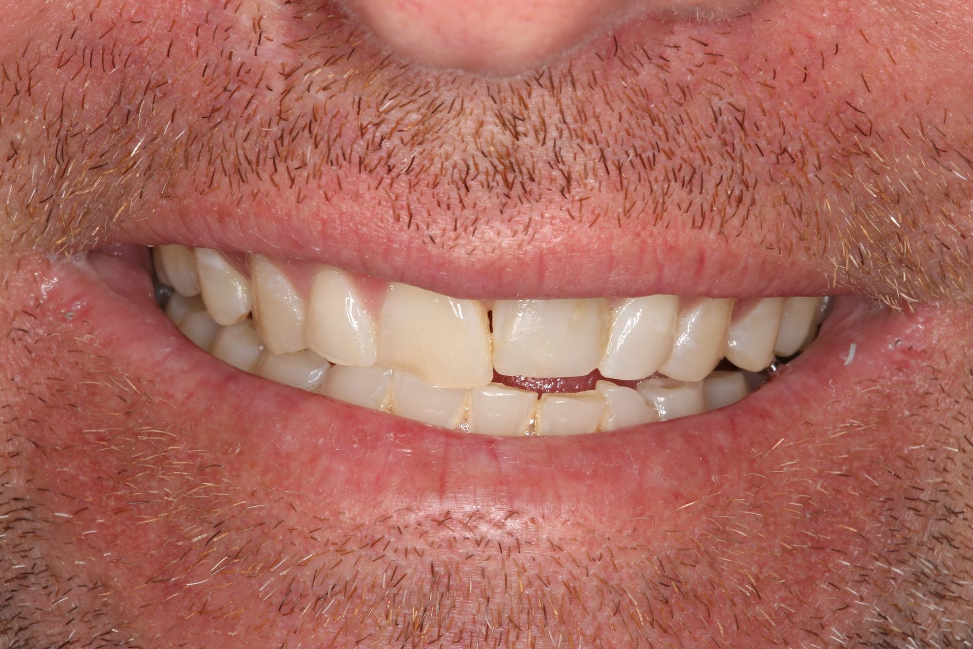 Close-up of a person's mouth showing a chipped front tooth and misaligned teeth.