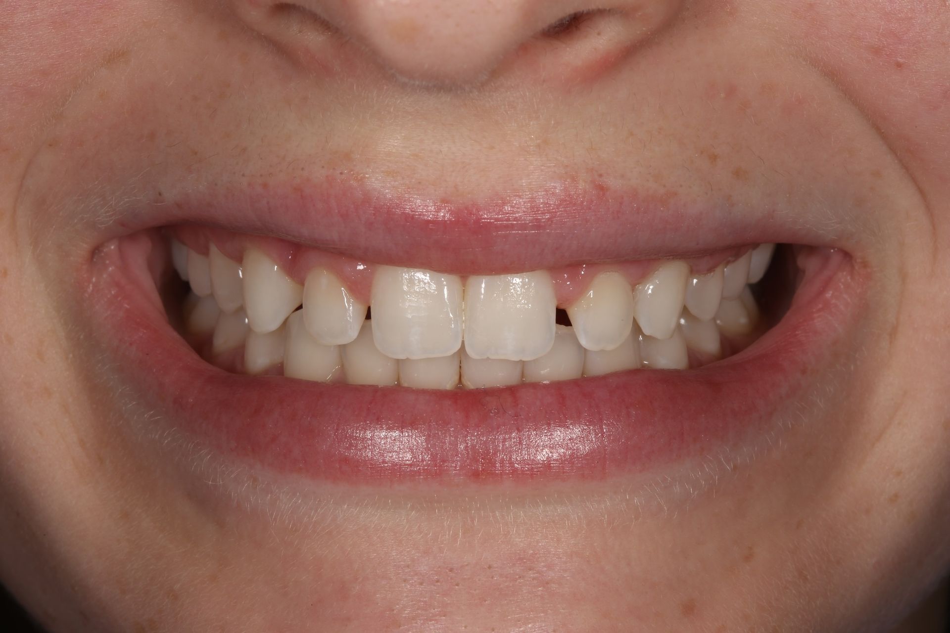 A close-up of a person's mouth with teeth slightly parted, showing a minor gap between the two upper front teeth.