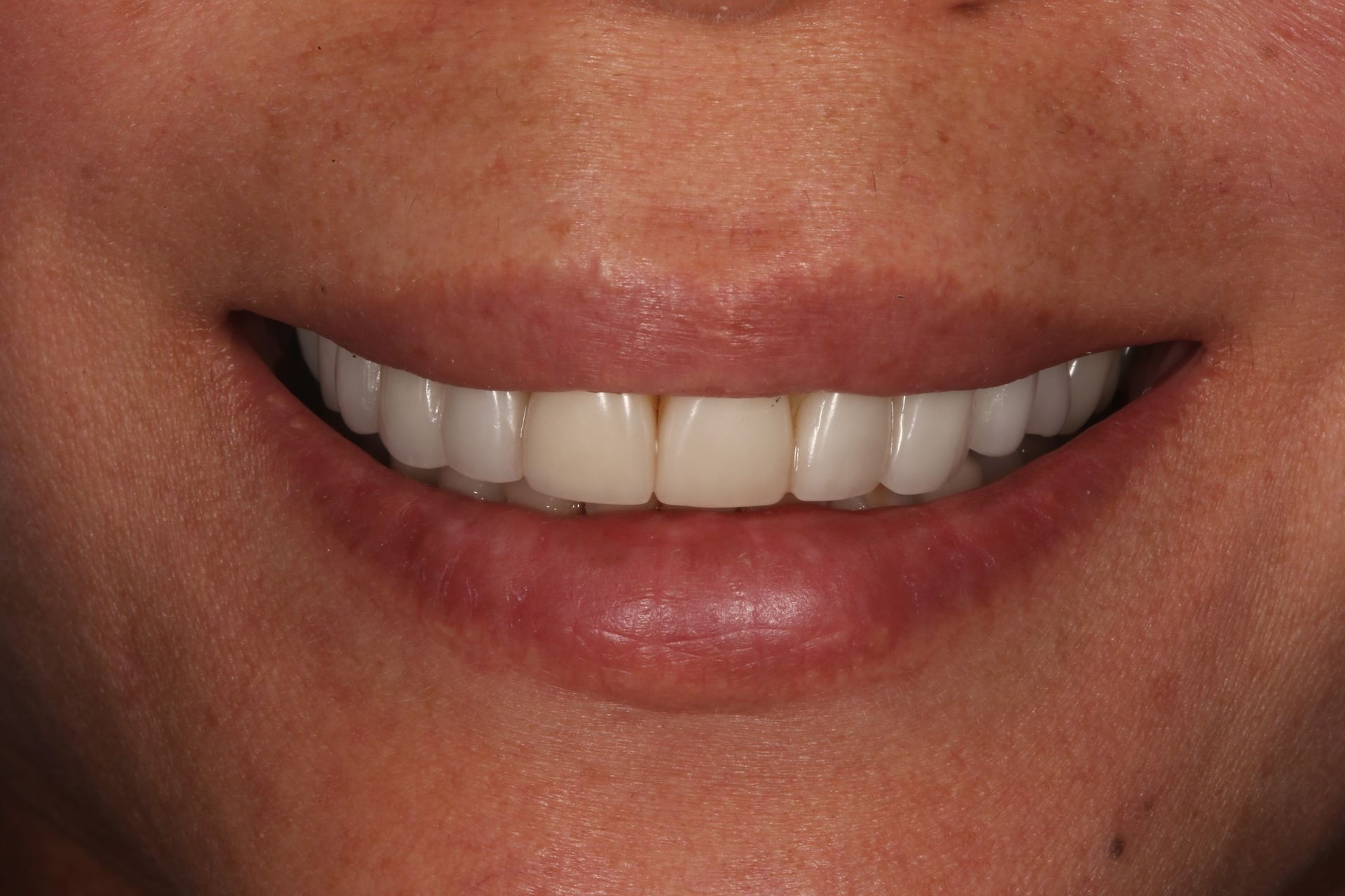 Close-up of a person smiling, showing a full set of straight, white teeth.