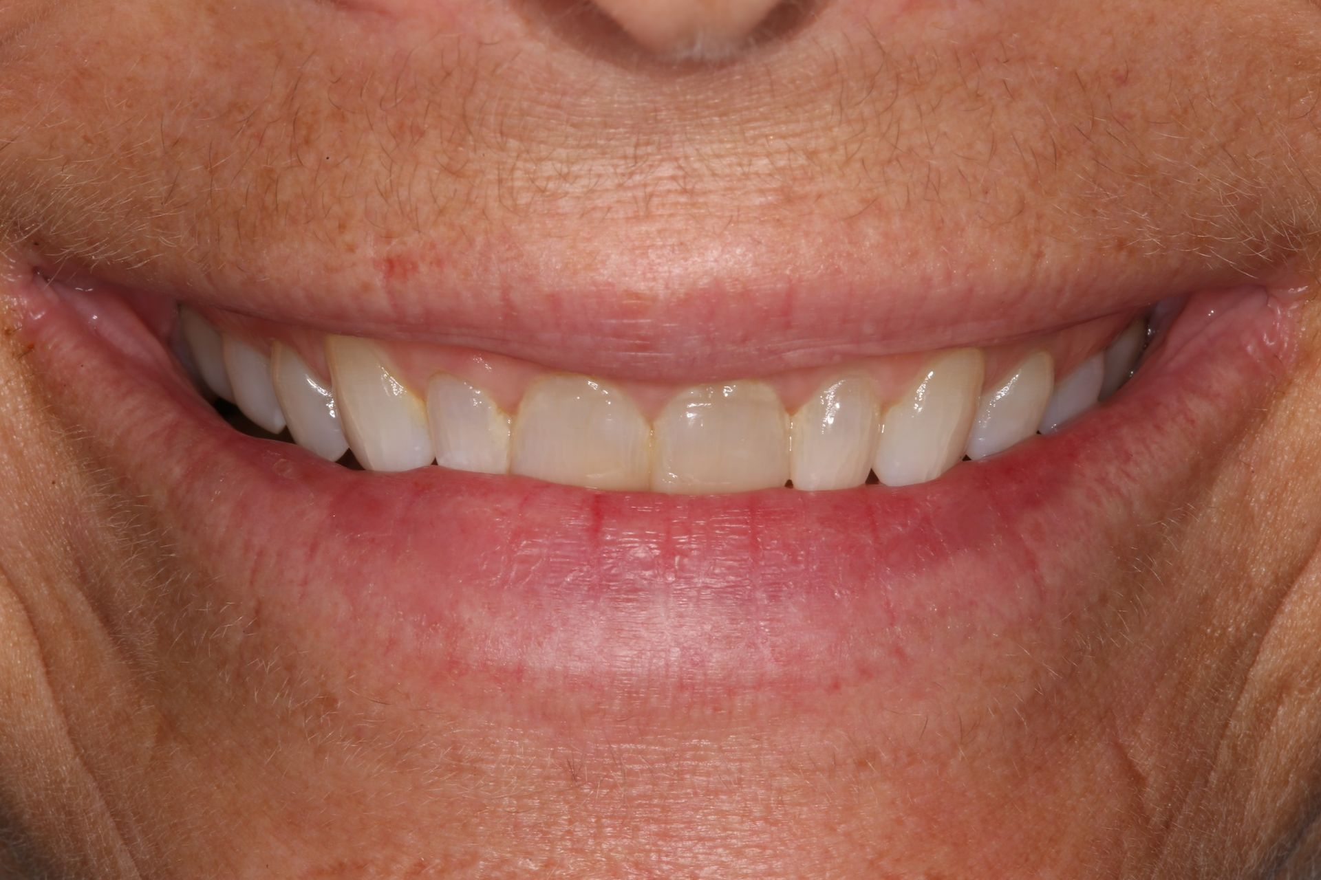 A close-up of a person smiling, showing straight, white upper teeth and a portion of their lower face.