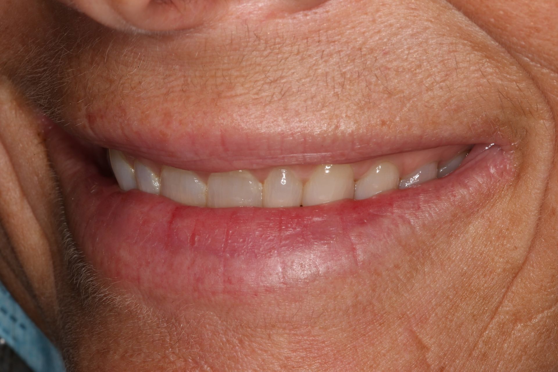A close-up of a person's mouth while smiling, showing natural, straight white teeth.