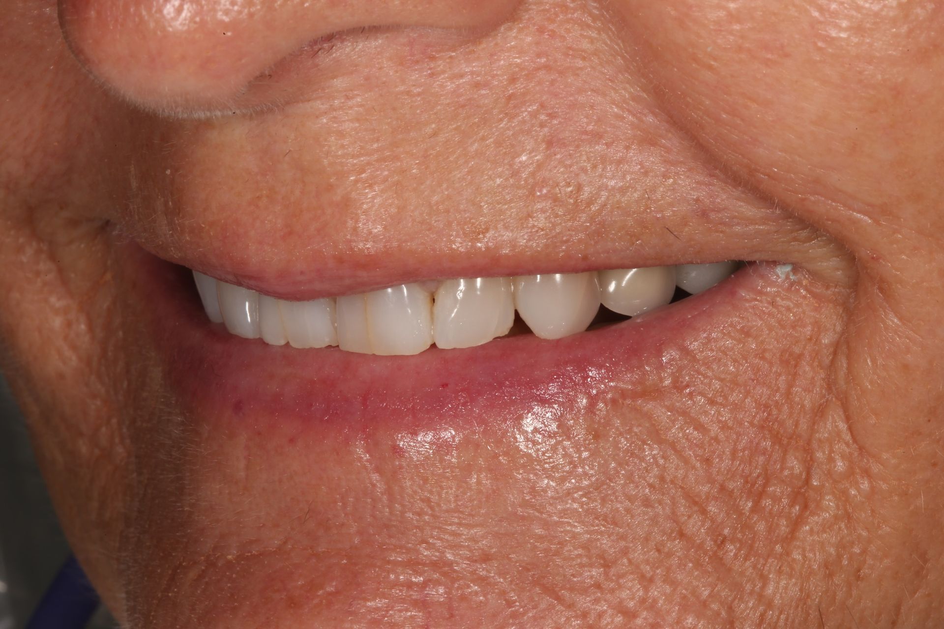 Close-up view of a person’s mouth showing upper teeth and a neutral facial expression.