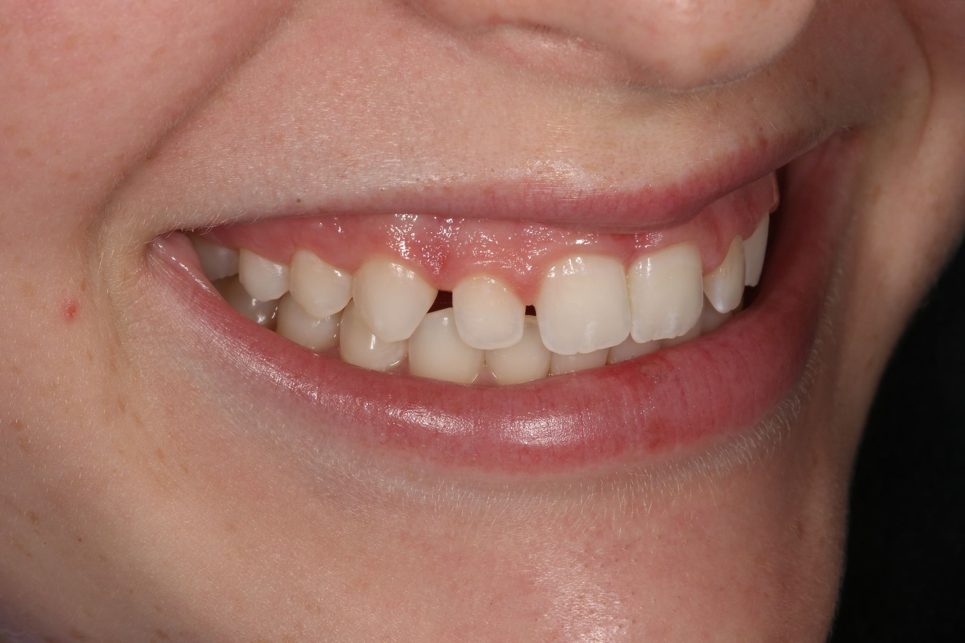 Close-up of a person's mouth with slightly crowded, misaligned teeth and a small gap between the two front upper teeth.