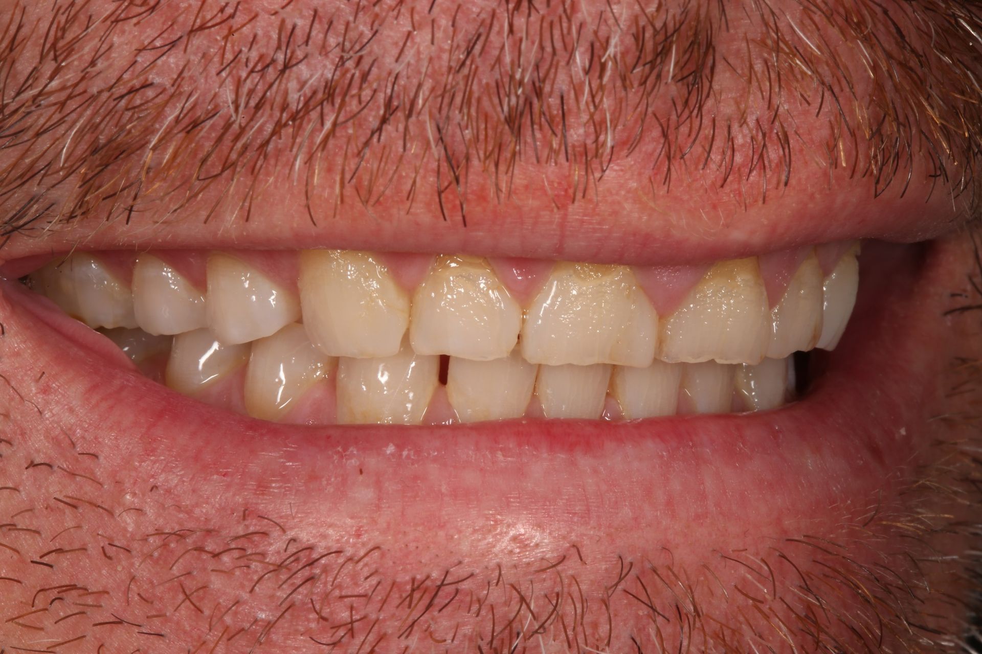 A close-up view of a person smiling, showing their teeth and part of their face with facial hair.