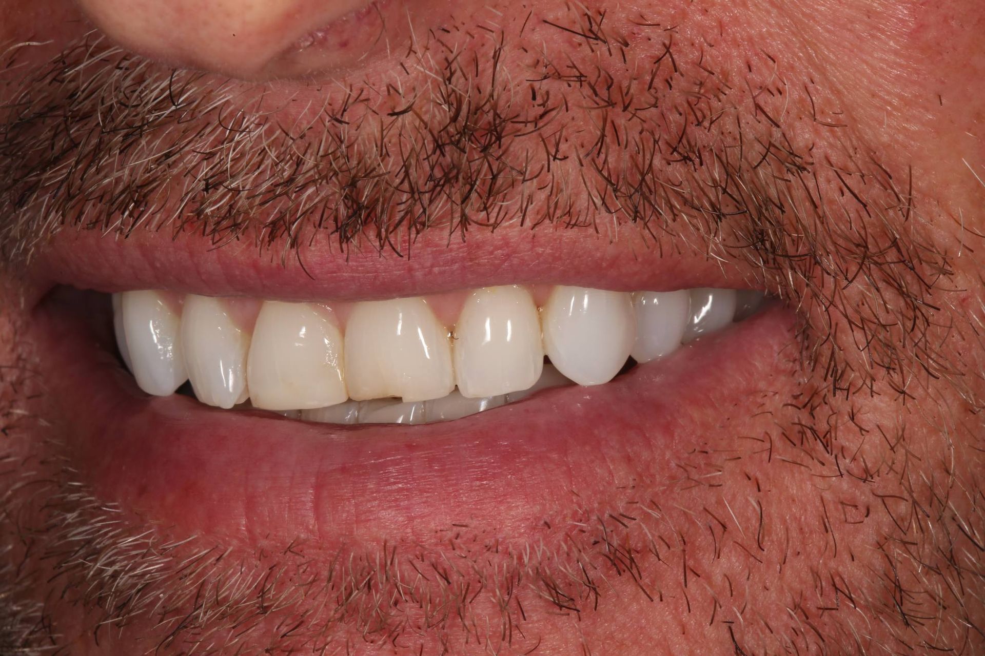 A close-up view of a smiling mouth showing a chipped front tooth.