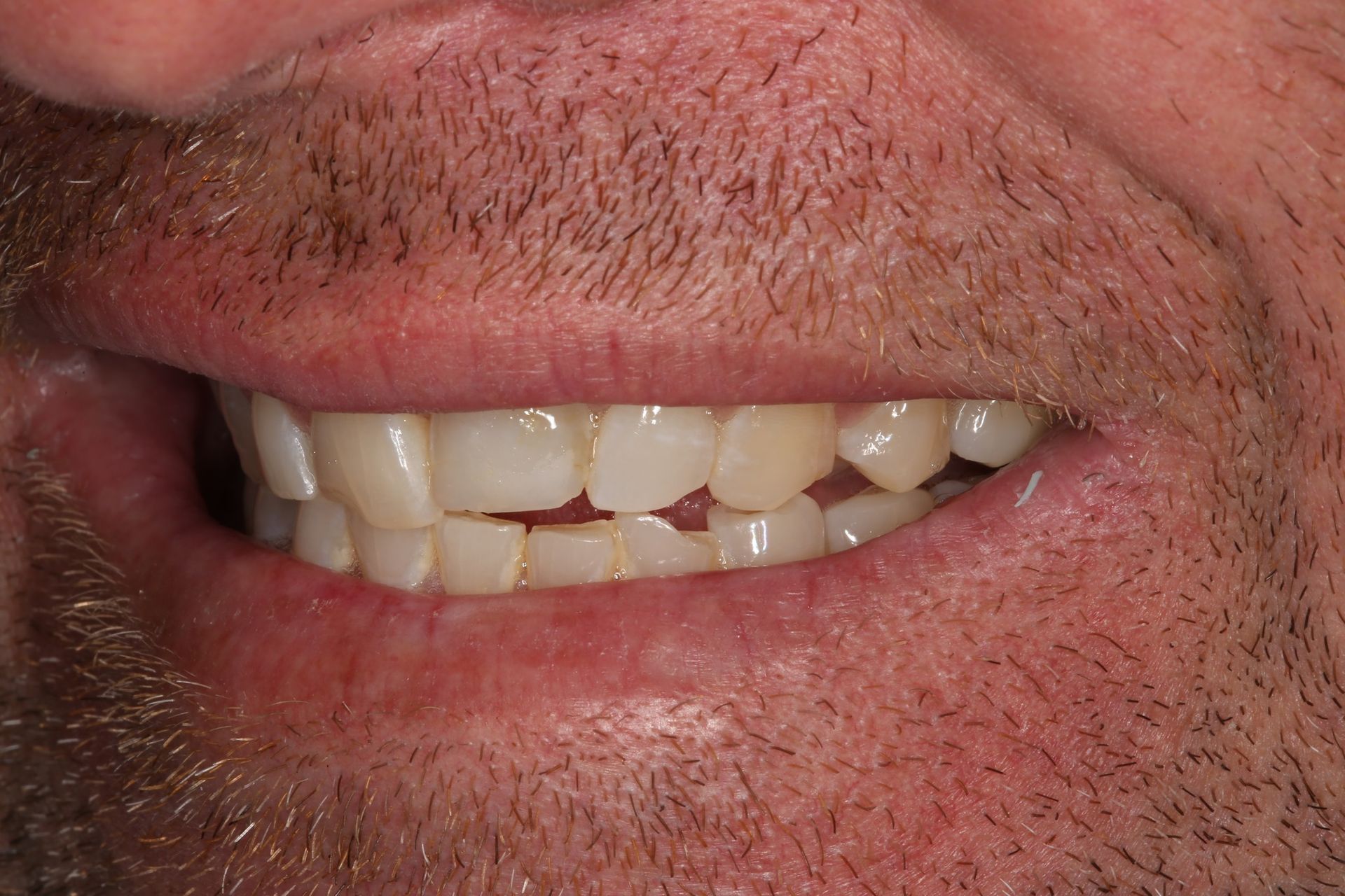 Close-up of a person's mouth showing slightly misaligned upper and lower teeth while smiling.