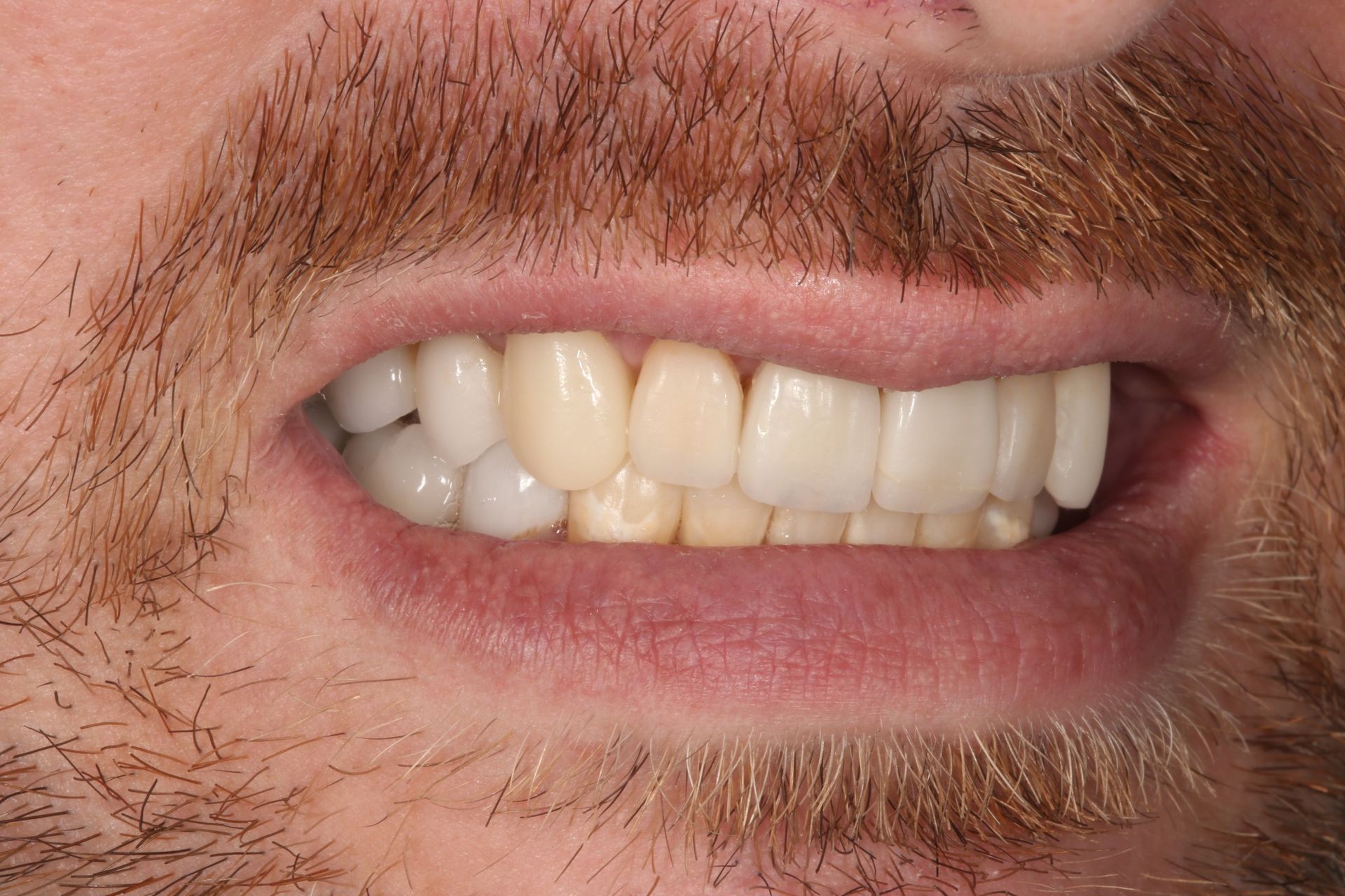 A close-up of a person's mouth showing teeth with mismatched shades of dental restorations and natural enamel.