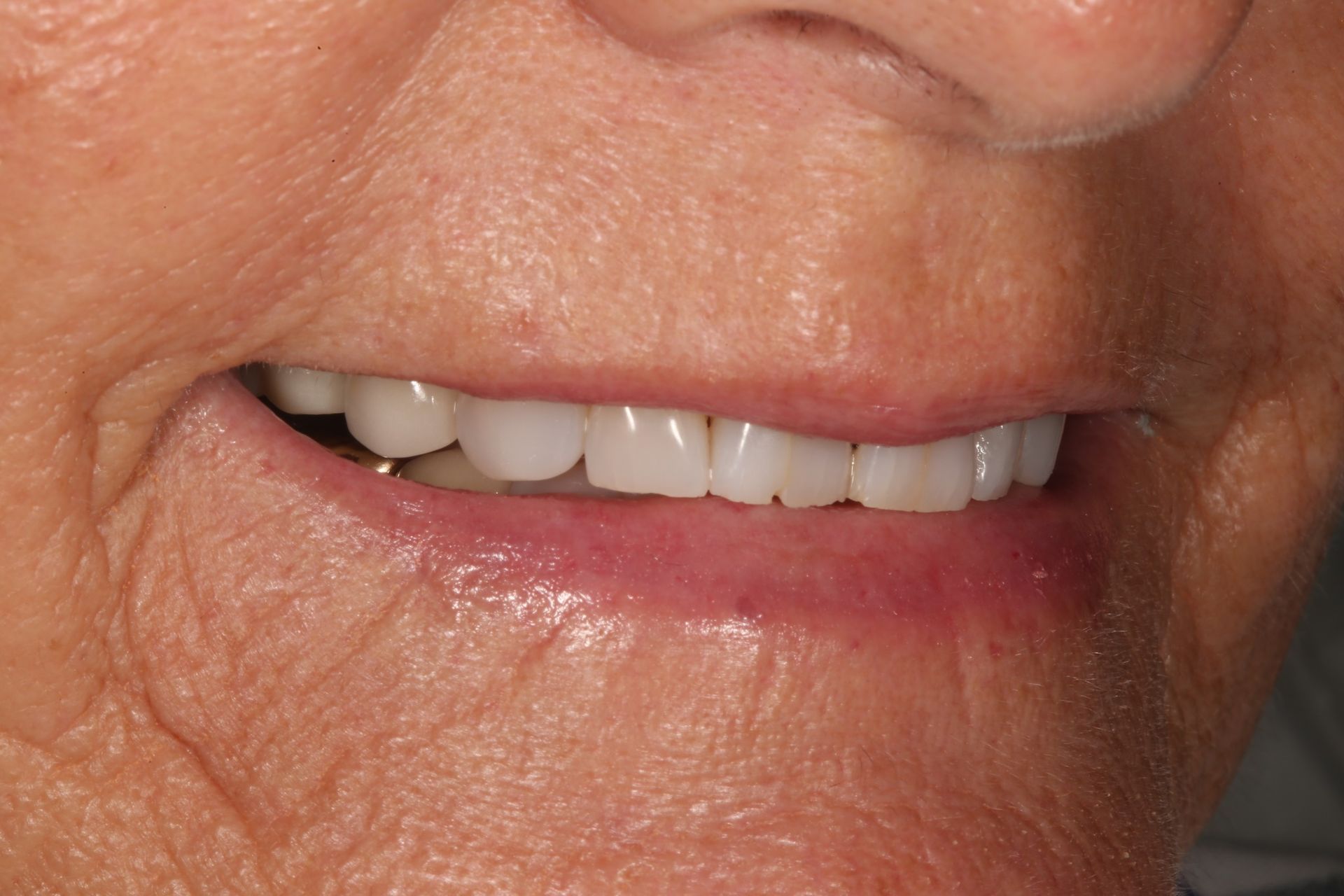 A close-up view of a person smiling, showcasing a set of natural-looking teeth and the surrounding lips and skin.