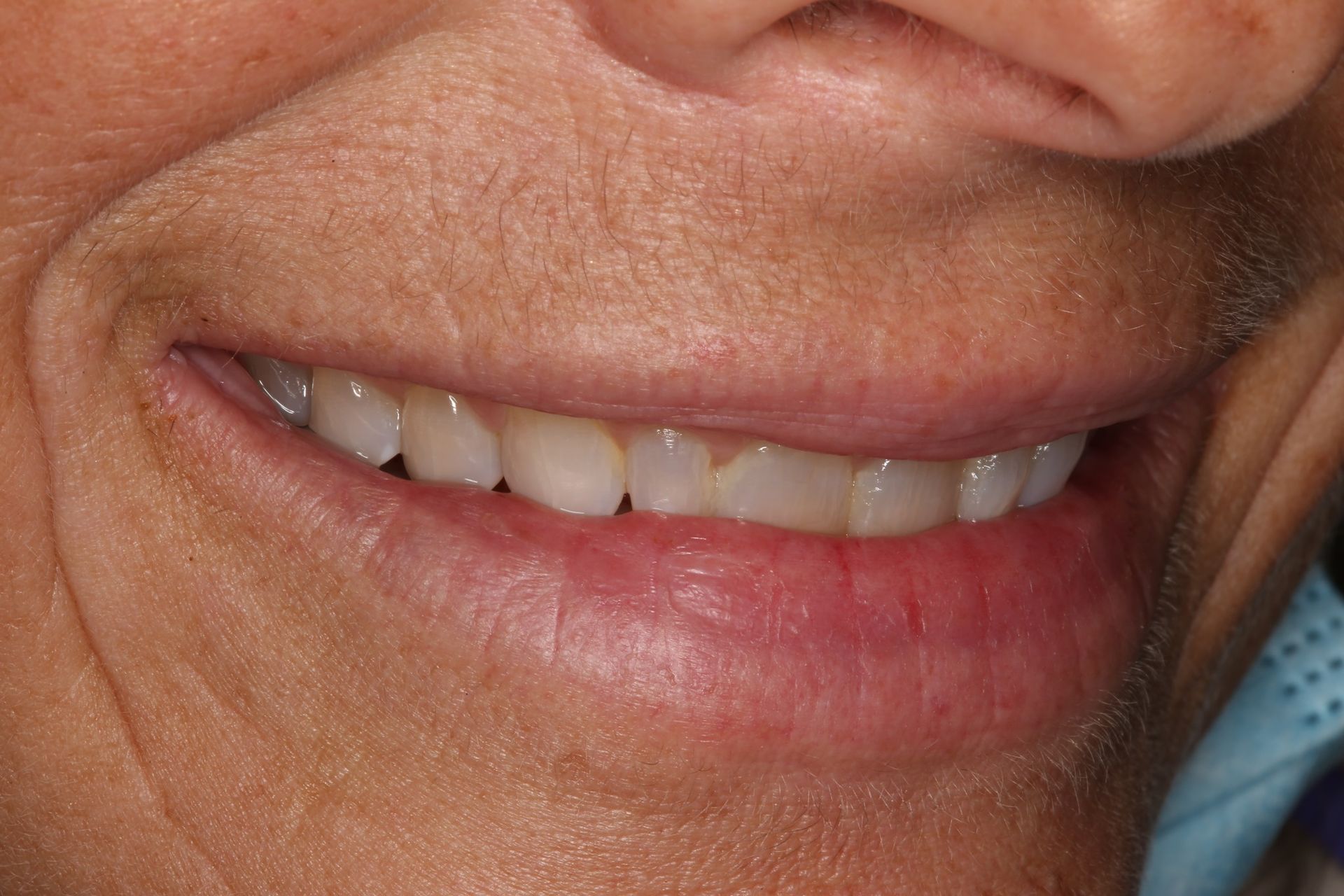 A close-up view of a person smiling, showing their upper teeth and mouth.