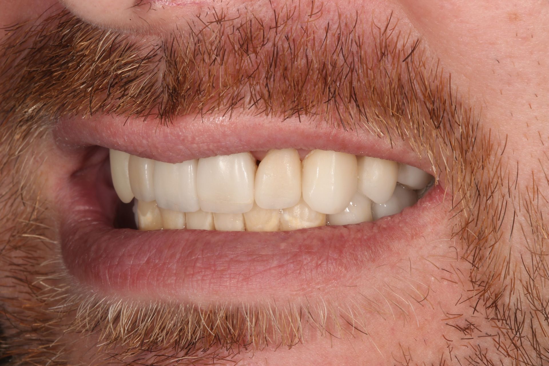 Close-up view of a person’s lower face showing teeth that appear to be dental veneers or crowns.