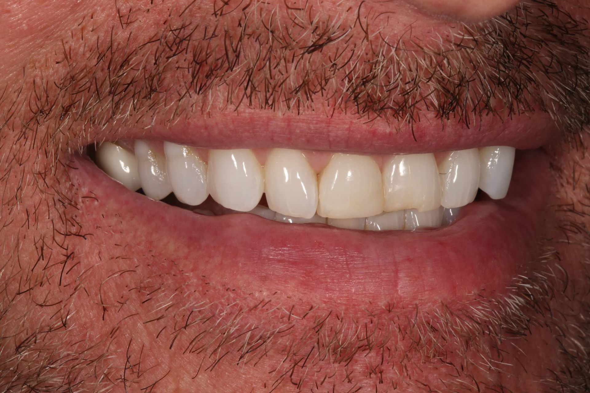 A close-up of a person's mouth with a smile showing well-aligned, natural-looking white teeth.