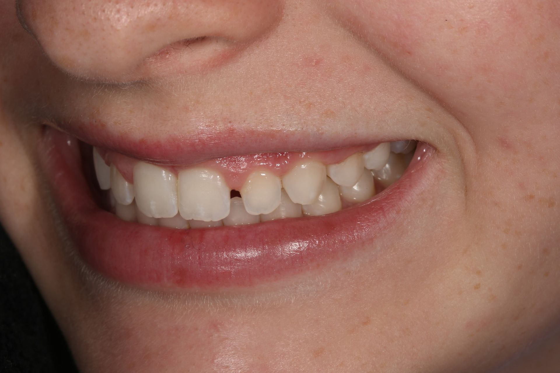 A close-up of a person's smiling mouth, showing a small gap between the two front teeth and slightly crowded upper teeth.