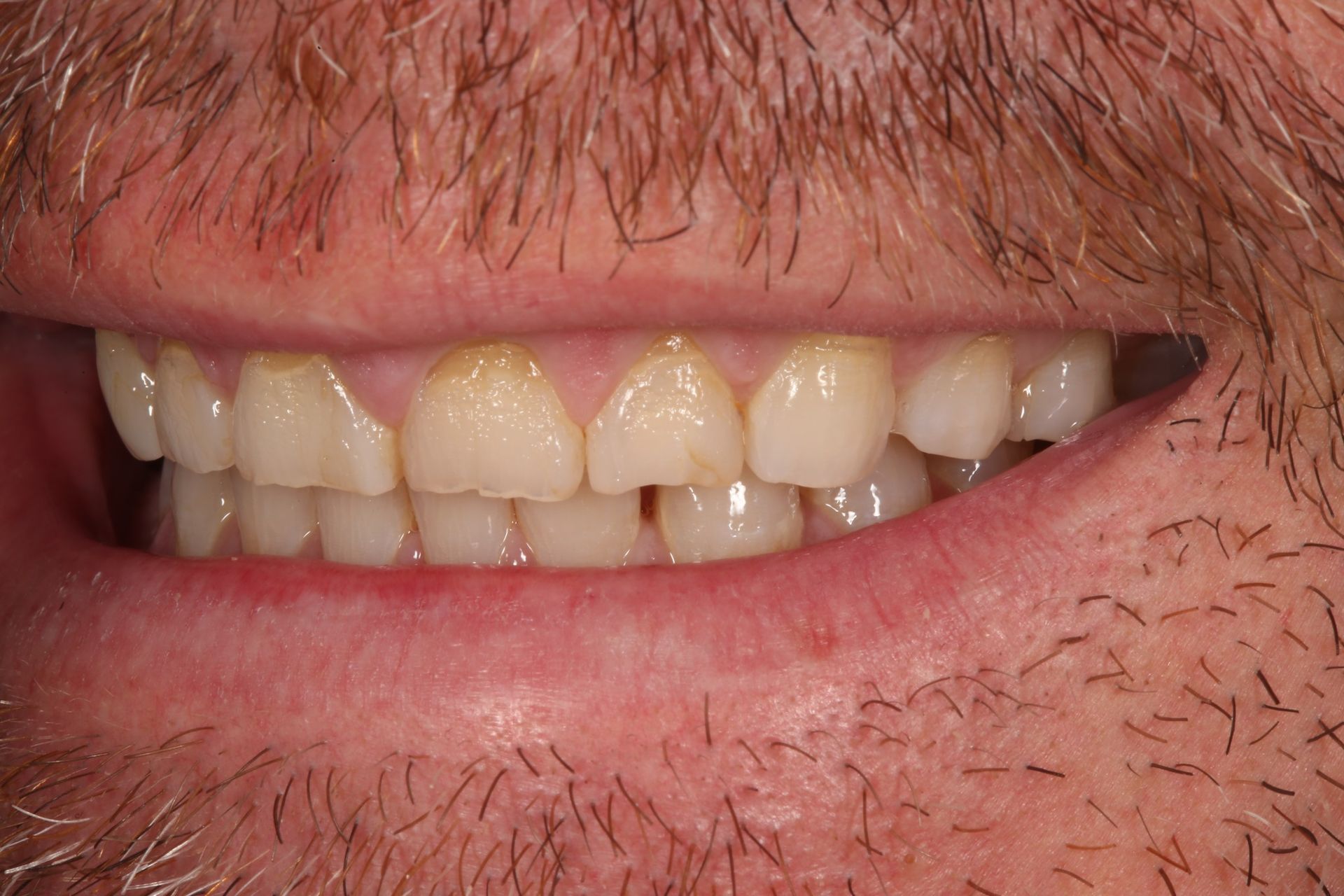 A close-up of a person's mouth and lower face, showing natural teeth with slight discoloration and wear.