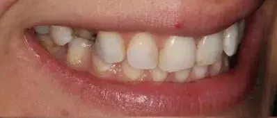 A close up of a person 's mouth with white teeth.