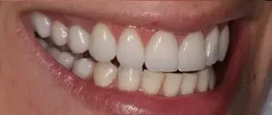 A close up of a person 's smile with white teeth.
