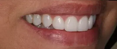 A close up of a person 's mouth with white teeth.
