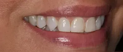 A close up of a woman 's smile with white teeth.