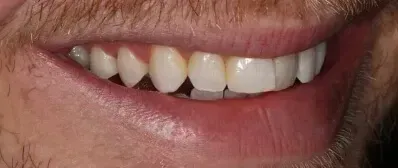 A close up of a man 's mouth with white teeth.