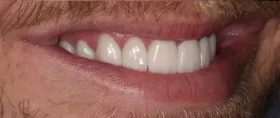 A close up of a man 's mouth with white teeth.