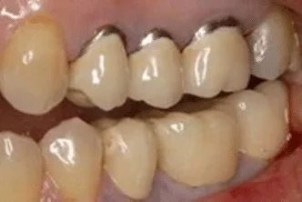 A close up of a woman 's smile with white teeth.